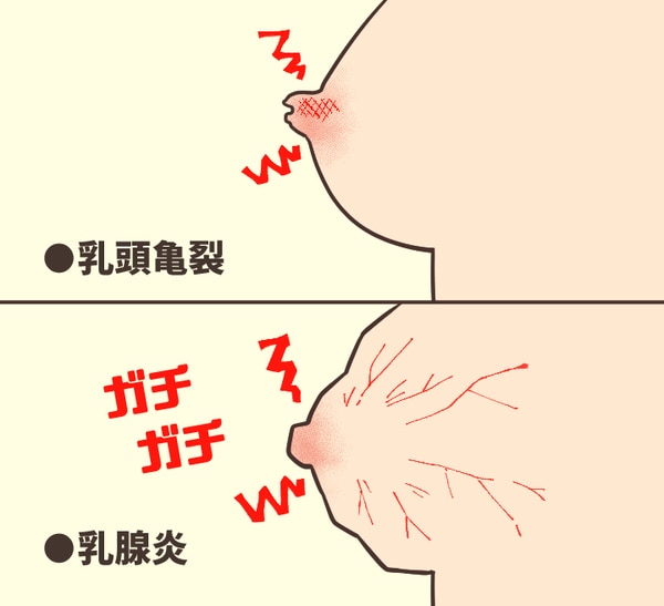 母乳育児でおっぱいにトラブルはある？